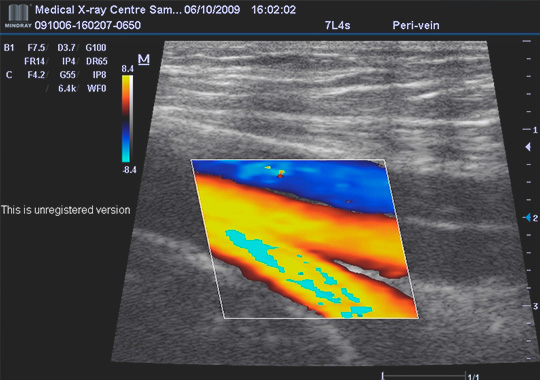 ультразвуковое дуплексное сканирование брахиоцефальных артерий